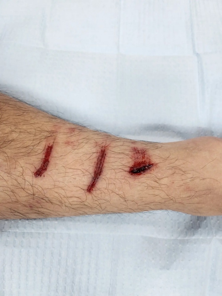 三道大血口！赵明剑晒伤口照：裁判没有VAR您是真看不见吗？